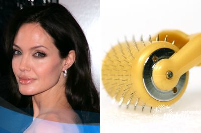 Dermaroller a 33 euros